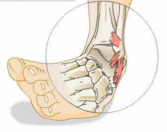 Indications Sprains Sprain is an injury to ligaments that is caused by being stretched beyond their normal capacity and possibly torn.