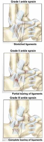 ) but are most common in the ankle.