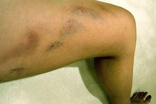 Indications Wound Care & Dr. Goed Applications Techniques Contusions: Injuries resulting from a forceful blow to the skin and soft tissue, however leaving the outer layer of skin intact.