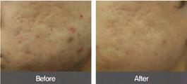 Scar laser is then applied on scarred skin surface to restore the skin back to its normal state.