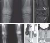 Osteoarthritis as an outcome of paediatric sport: an epidemiological perspective Dennis J Caine and Yvonne M Golightly Br J Sports Med 2011 45: 298-303 (A) Standing frontal radiograph of both knees