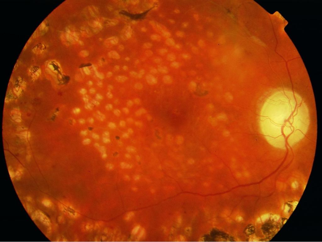 Laser intervention Diabetic macular edema Clinical significant