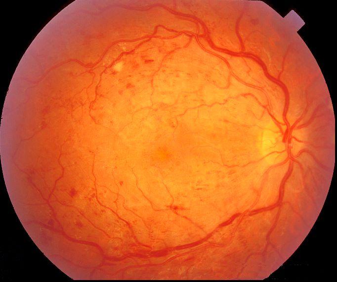 Laser intervention Nonproliferative and proliferative DRP Mild and moderate nonproliferative DRP No photocoagulation (unless for macular edema) Severe and very severe nonproliferative DRP (4-2-1