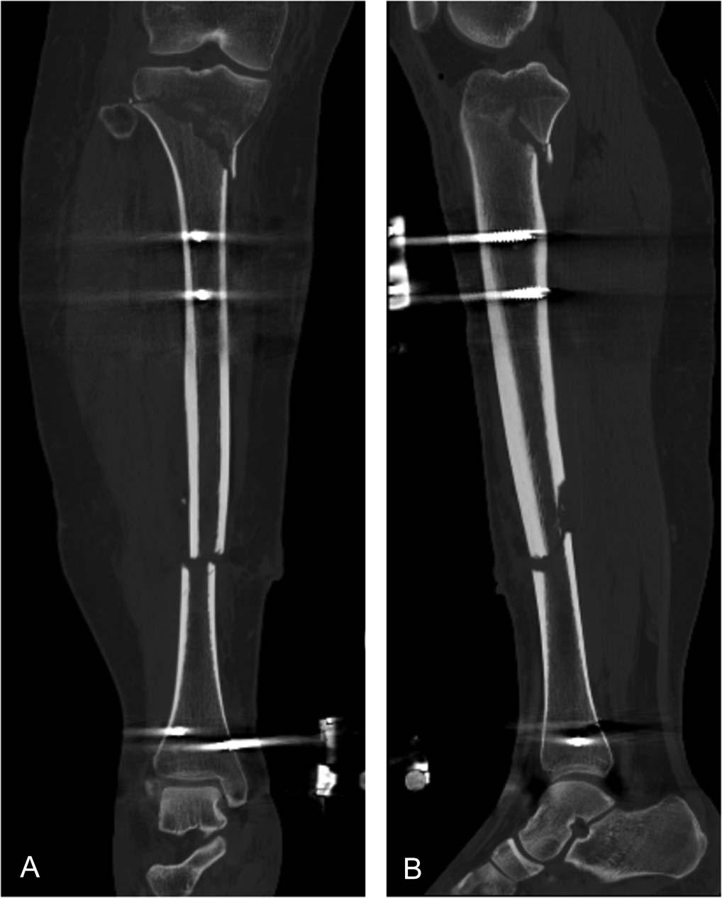 injury. During the same procedure, a hexapod external fixator was placed, and the diaphyseal fracture bone ends were acutely shortened and compressed, whichassistedwiththewoundclosure.