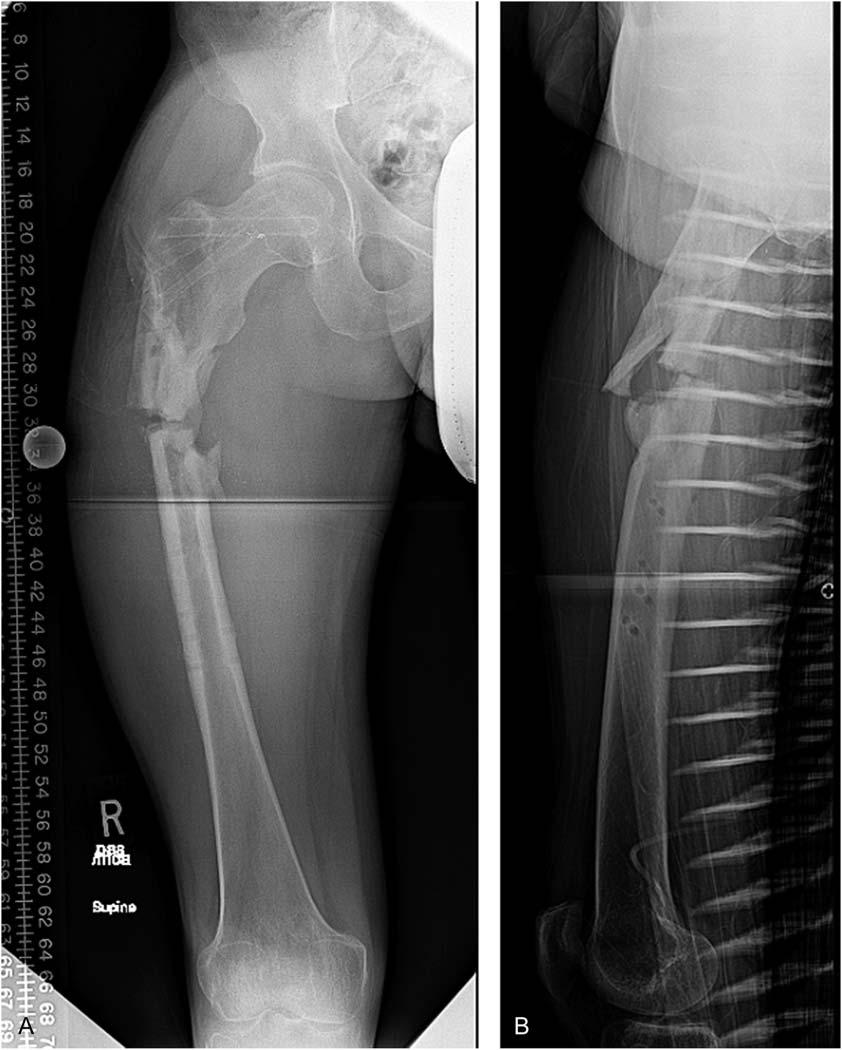 AP radiograph soon after fixation. A trochanteric IM nail was used through a piriformis entry point to prevent against varus angulation at the fracture site.