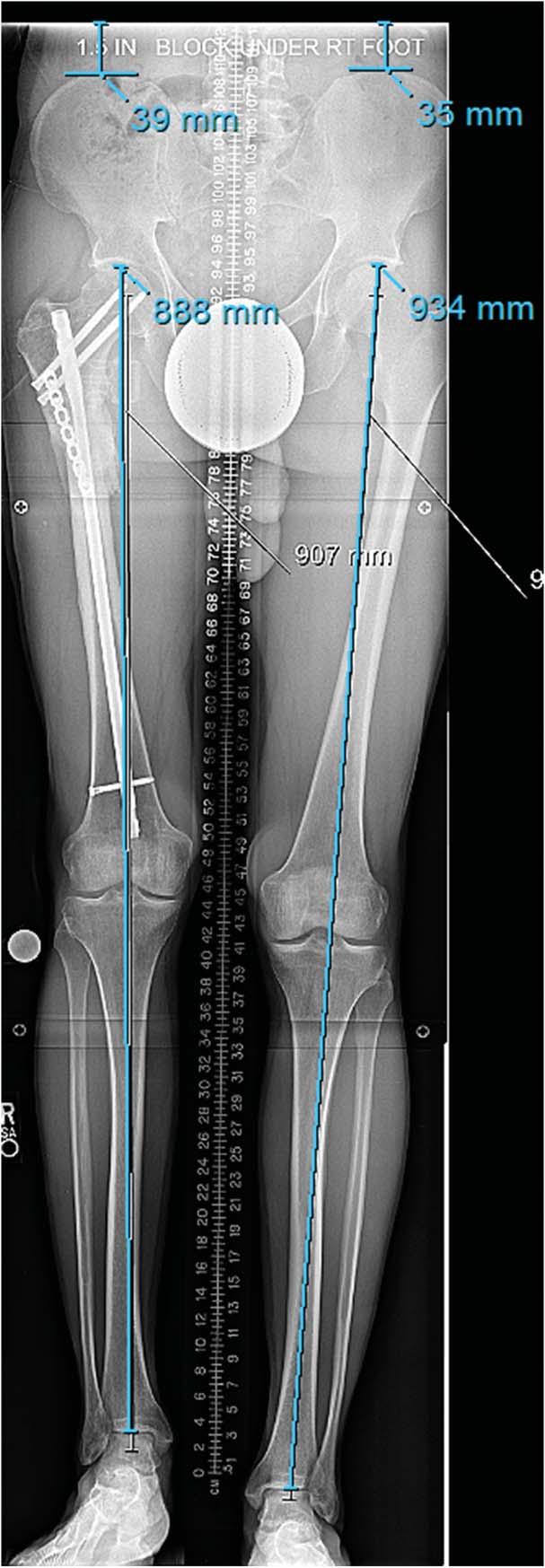 Fragomen J Orthop Trauma Volume 31, Number 6 Supplement, June 2017 FIGURE 7. A long, standing, bipedal 5100 radiograph showed a 40 46 mm limb length discrepancy with the right side shorter.