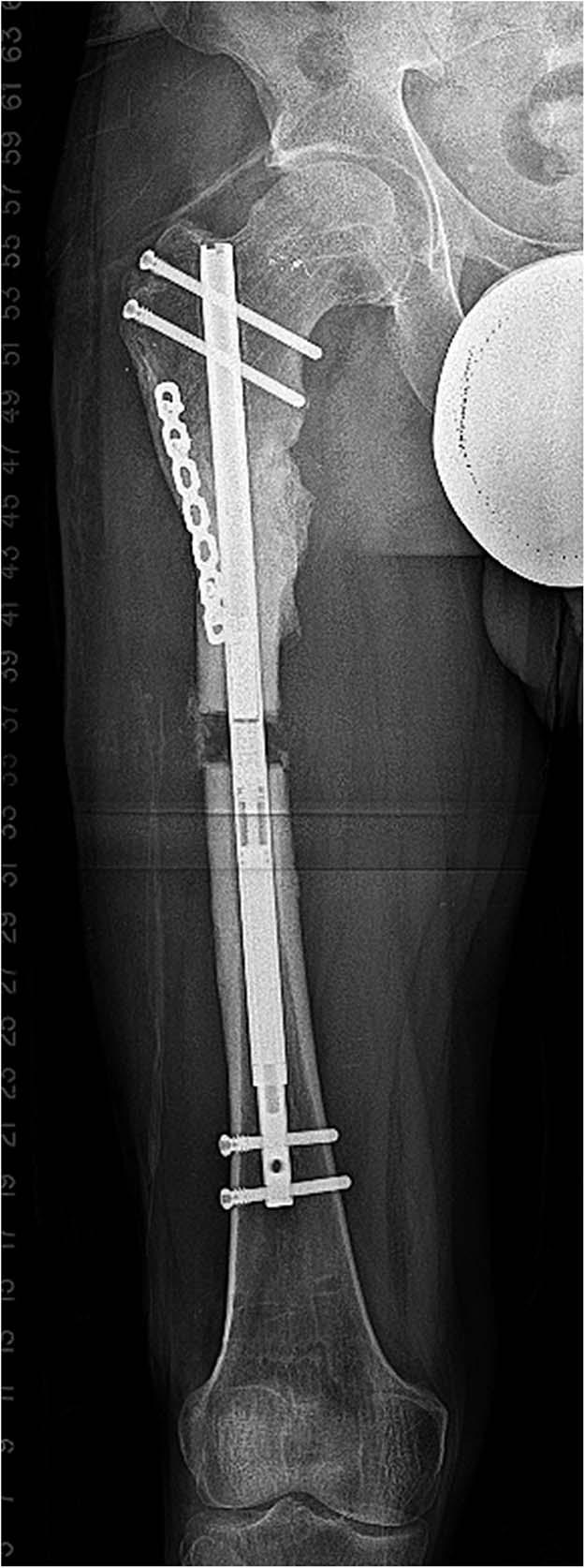 He was placed in traction and a CT scan, obtained for surgical planning, provided detail on the extent of poorly vascularized bone at the fracture site.