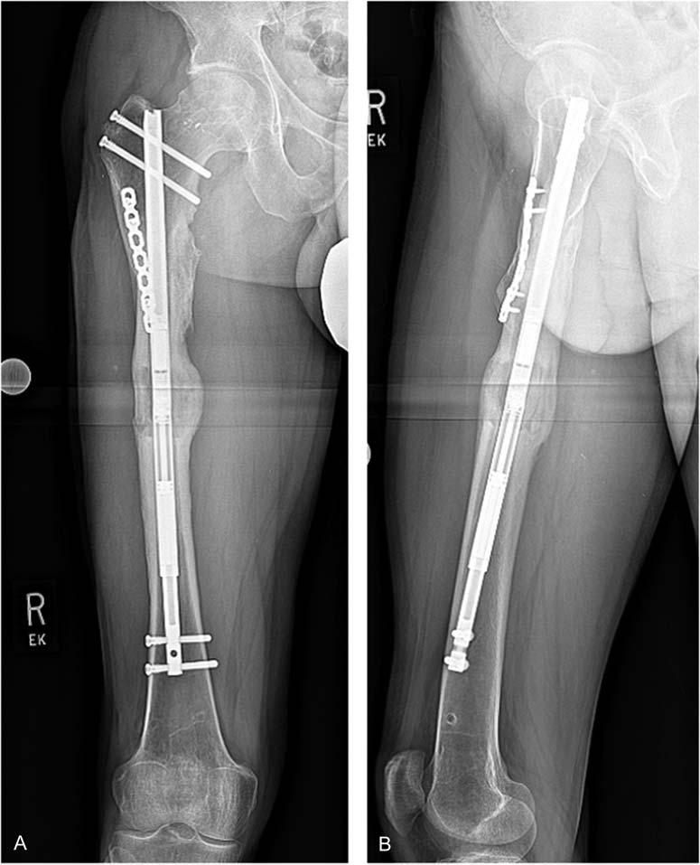 He was treated in a major medical center in Thailand where he underwent open reduction and internal fixation.