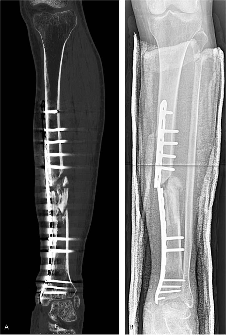 A long-standing x-ray is obtained to confirm limb length and alignment at the end of distraction. FIGURE 11.