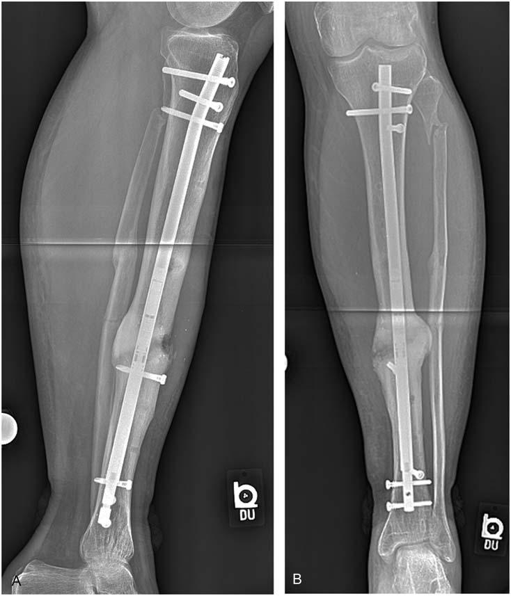 J Orthop Trauma Volume 31, Number 6 Supplement, June 2017 Lengthening and Compression Nail been limited to recalcitrant nonunions where standard techniques have a high likelihood of failing.