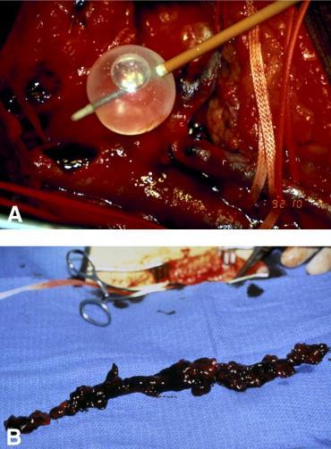 Traditional intervention - Surgical thrombectomy Surgical removal of thrombus +/- AV fistula Better patency rates, lower