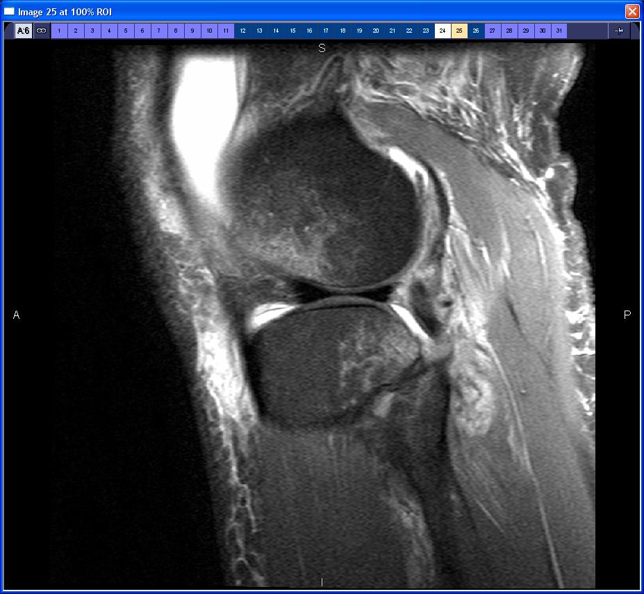 Pivot ShiV Injury: Marrow Contusion Classic bone bruise pa?