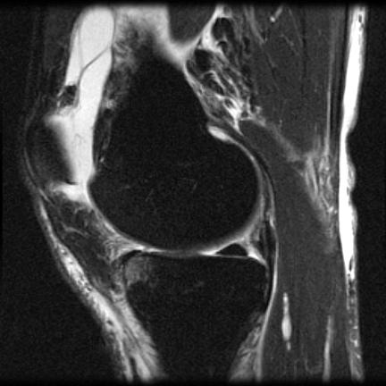 ern of anterior /bia, posterior patella Associated with PCL