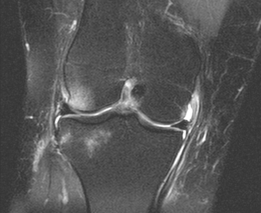 MFC Edema Avulsion of the meniscofemoral ligament component of the deep MCL (dmcl) 73% of MFC edema had tears of the dmcl (OR=7.6, p<.