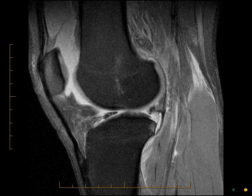 Meniscal Tears 41-68% of acute ACL injuries in adults Up to 79% in pediatric popula/on Lateral more