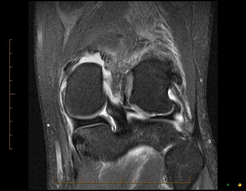 Meniscal Tears O Donoghue s Terrible Triad of ACL, MCL and MMT is unusual ACL, MCL and LMT more common
