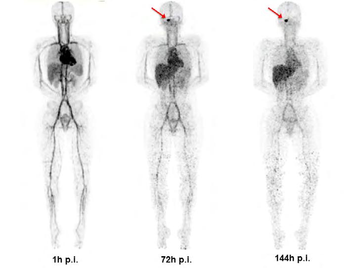 89 Zr-bevacizumab PET in DIPG A 3 1h p.i. 72h p.i. 144h p.i. B SUV mean (tumor) 6.0 4.0 2.0 C Mean tumor/blood SUV ratio 1.5 1.0 0.