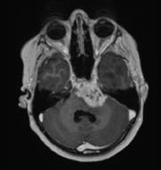 2A), including the VTM, primary tumor, CMM, and a small 0.02-g fragment of dural metastasis that was previously undetected by MRI and PET (Supplementary Fig.