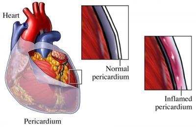 PERICARDIUM Pericardial cavity Between visceral and parietal