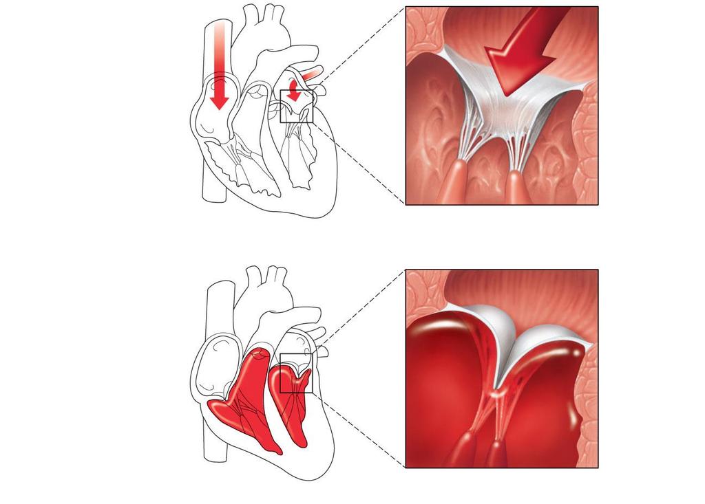 1 Blood returning to the heart fills atria, putting pressure against atrioventricular valves; atrioventricular valves are forced open.