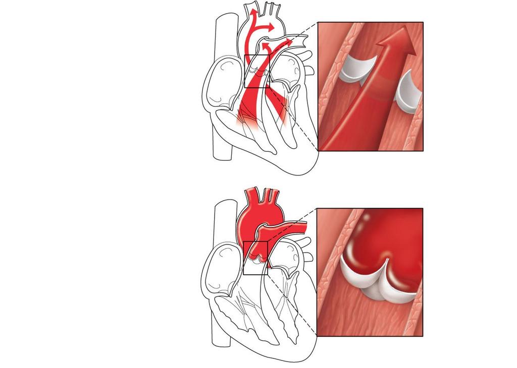 Aorta Pulmonary trunk As ventricles contract and intraventricular pressure rises, blood is pushed up against semilunar valves, forcing them open.