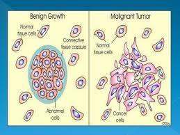 Cancer and carcinogens A tumour is a mass of abnormally growing cells. There are two types of tumour. Benign tumours: Growths of abnormal cells contained in place, usually within a membrane.