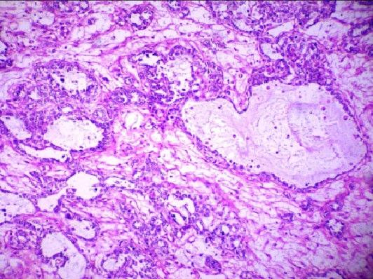 Yolk sac tumor (Fig. 8) comprised 3 % of total GCT, 15, 44, 46 findings similar to many studies. Fig. 8. Yolk sac tumor showing tumors cells arranged in microcytic and macrocystic patterns (H&E; 20X).
