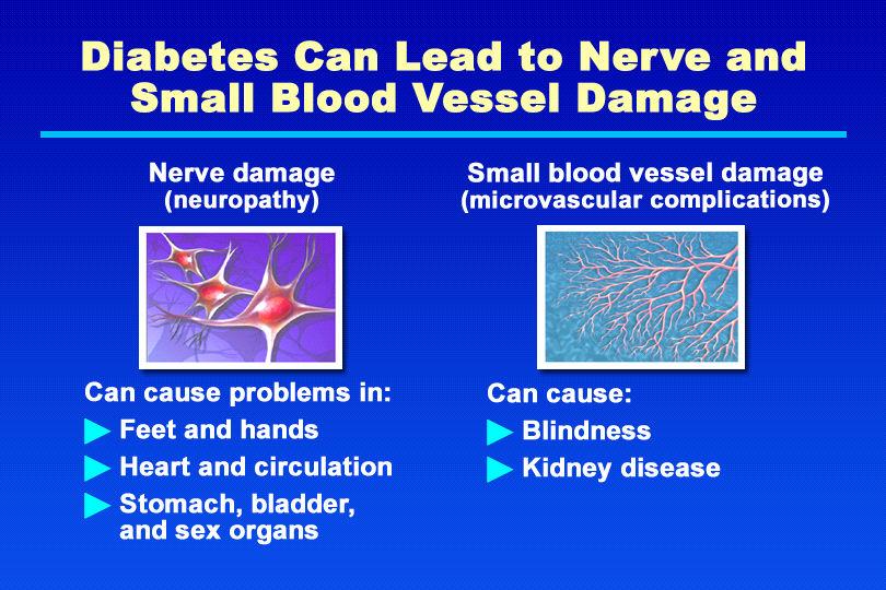 Diabetes Can Lead to Nerve