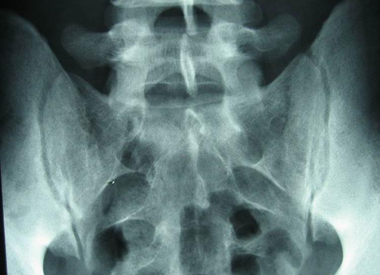 Imaging X-ray (radiographic) sacroiliitis Not all patients who have axial SpA will exhibit radiographic features.