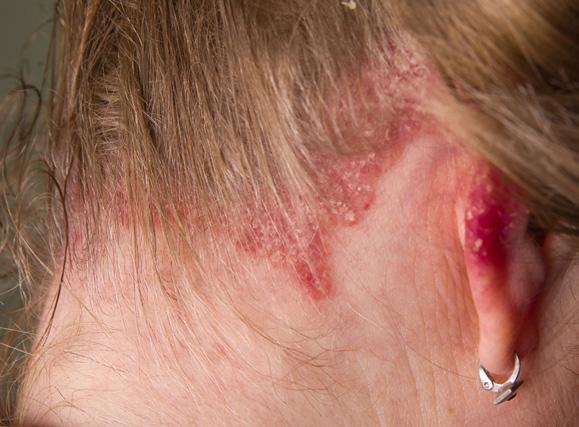 Plaques may be present on any area of the body, including the scalp and nails.
