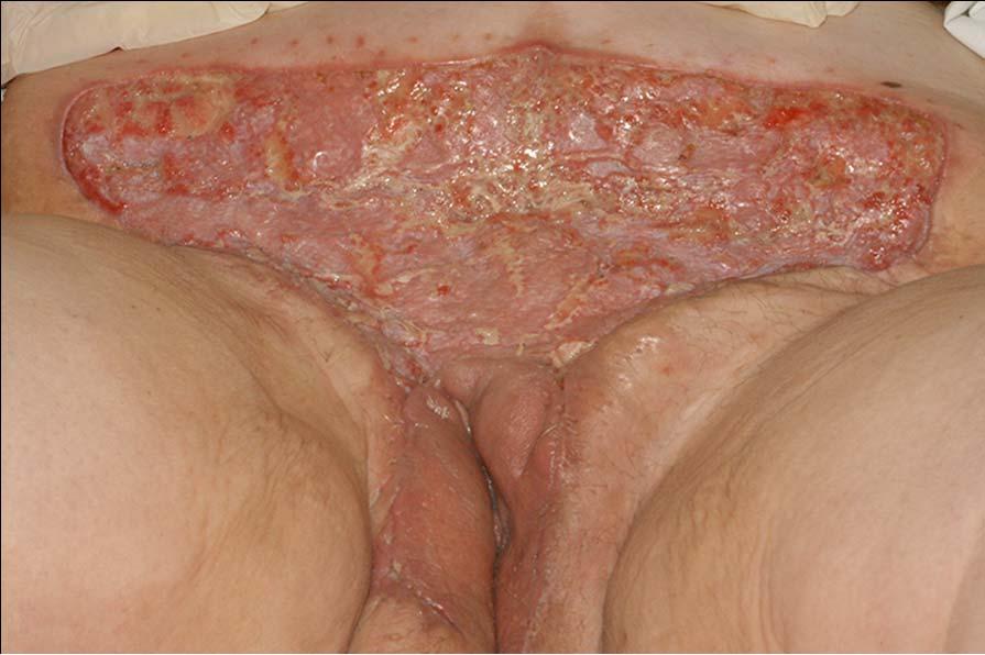 Skin Graft No recent follow up was doing well but only saw her 3 months out from surgery (multiple personality disorder)