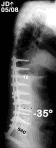 7/31/2012 PSF T10-S1 and TLIFs L3-S1 Indications for PSF lumbar curve + ASF ± stenosis