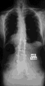 sagittal balance Thoracic hyperkyphosis Fixed deformity Silva FE, Lenke LG.