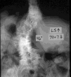 7/31/2012 Etiology Asymmetric degeneration, which then leads to: Increased asymmetric load Progression of degeneration and deformity Scoliosis Kyphosis May create mono- or multisegmental instability