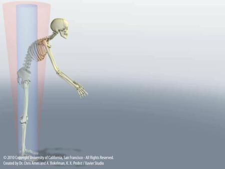 Reciprocal Changes of Pelvis PT and planning Location of Osteotomy and Impact PSO level correlated to