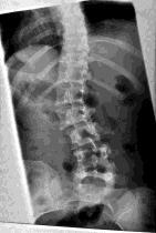 Lumbar Idiopathic Scoliosis 47 year