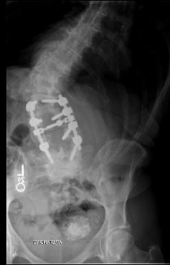 VuMedi Webinar Multi-Center Grand Rounds Spine Deformity Case Discussions Complications and Revision Cases Christopher I.