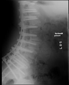 spacers using Infuse rh-bmp-2 (6 mg per level) Posterior re-exposure, replacement of several loose screws with L1 through S1 and iliac instrumentation revision,