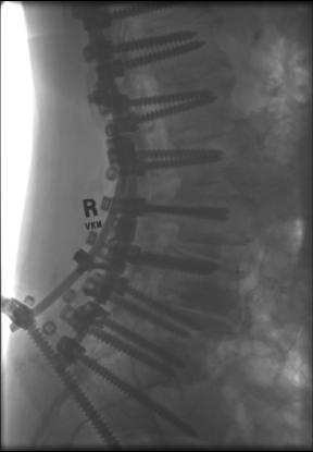 0 mm CoCr rods) SPO at T12-L1 level with T5 and T6
