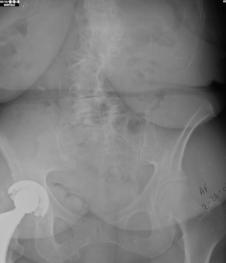 7/31/2012 Indications for Decompression Alone Central and lateral recess stenosis Stable spine radiographically Minimal/absent rotatory subluxations Osteophytes