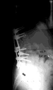 7/31/2012 PSF T11-L5, Decompression L2-L5 Indications for Decompression with PSF Lumbar Curve ± stenosis Severe rotatory subluxations/ unstable spine back pain/deformity complaints Adequate sagittal