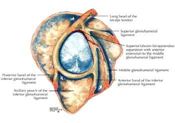 Type VI: An unstable flap tear of the labrum is present in addition to