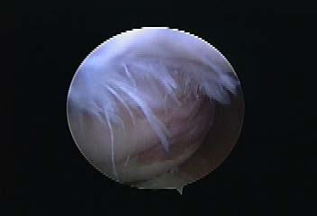 SLAP Lesion Arthroscopic View Overhead Throwing