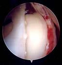 ?? Partial Undersurface Infraspinatus Tear