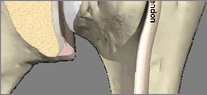 It is a tear at the top of the shoulder socket where the biceps tendon attaches.