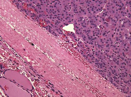 Case Reports in Endocrinology 3 Figure 2: Photomicrograph of thyroid nodule reported as follicular adenoma at outside institution in 1996.