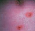 Pityriasis lichenoides chronica The appearance and distribution of the small, oval, salmon-coloured macules on the patient s trunk point to the diagnosis of pityriasis rosea ( b).
