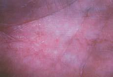 Atopic dermatitis c. Contact dermatitis d. Dermatophyte infection e. Psoriasis A second KOH evaluation reveals a dyshidrosiform reaction to a dermatophyte infection ( d).