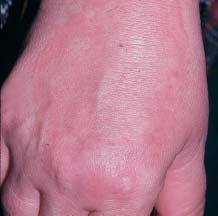Case 5 Cortisone Cream Didn t Help! A 35-year-old man complains of a mildly itchy rash on the dorsum of his right hand, which has been present for over a year.