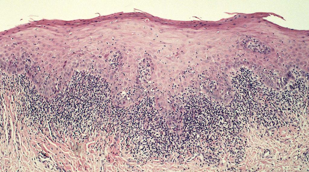 Lichen Planus Histology Keratosis, basal cell damage, thickening of the